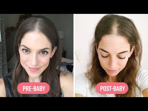 How I Coped With Extreme Hair Loss After Pregnancy I Mom Bod