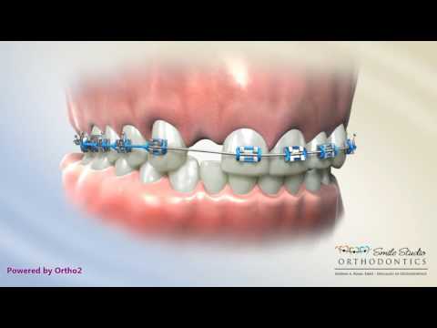 Bonded Bridge - Orthodontic Treatment